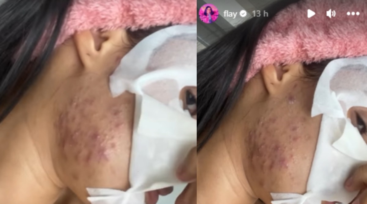 Flay já enfrentou problema com acne — Foto: Reprodução Instagram