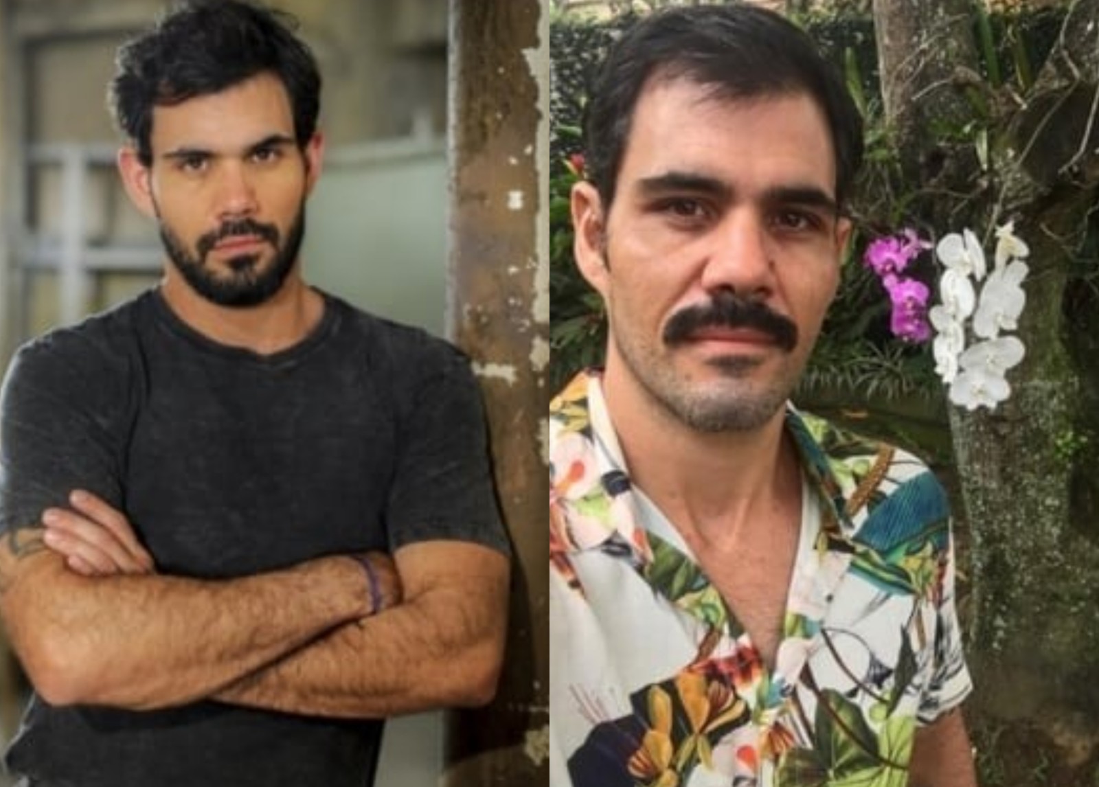 Otoplastia: antes e depois do ator Juliano Cazarré