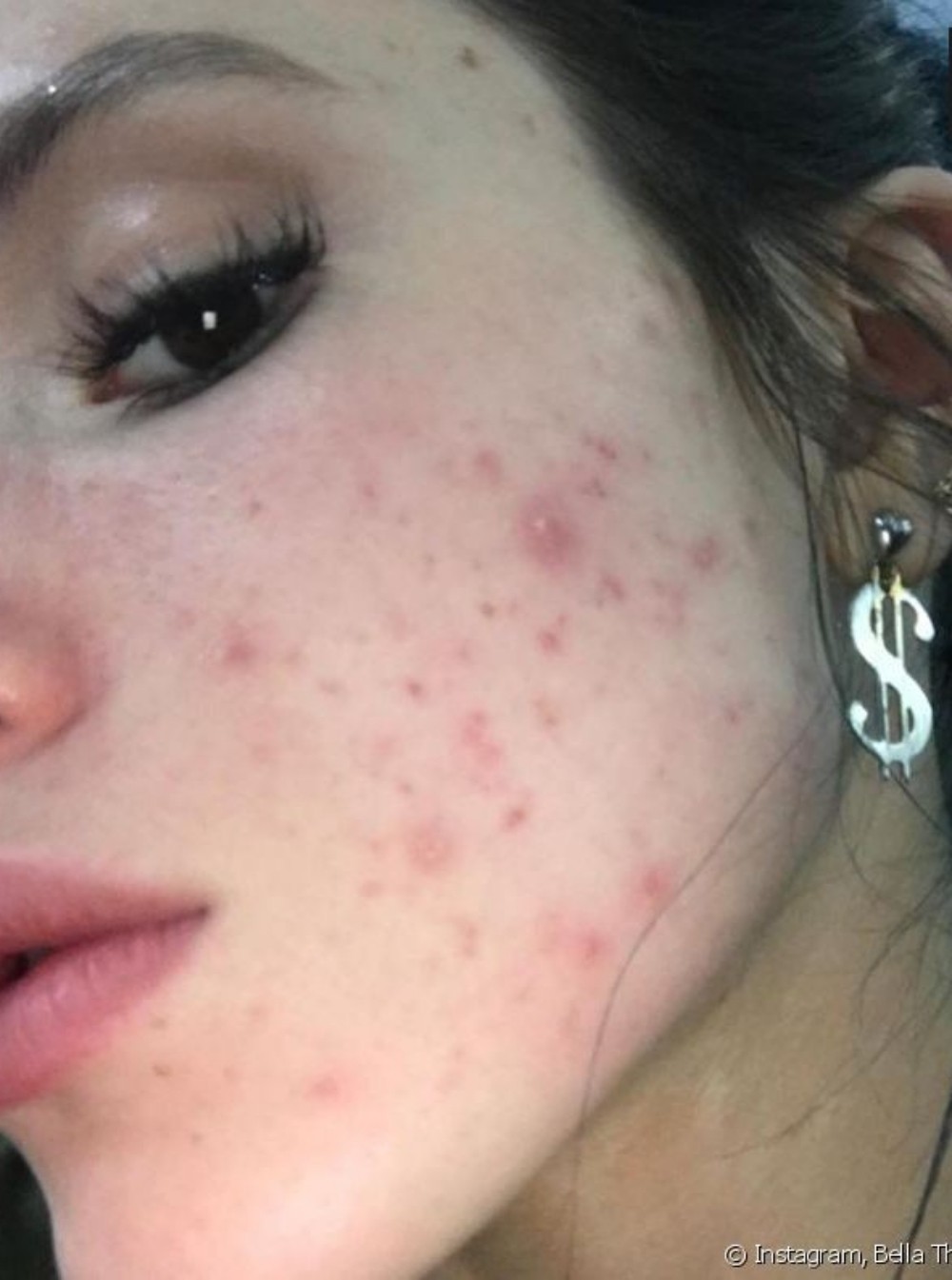 Bella Thorne já enfrentou problema com acne — Foto: Reprodução Instagram