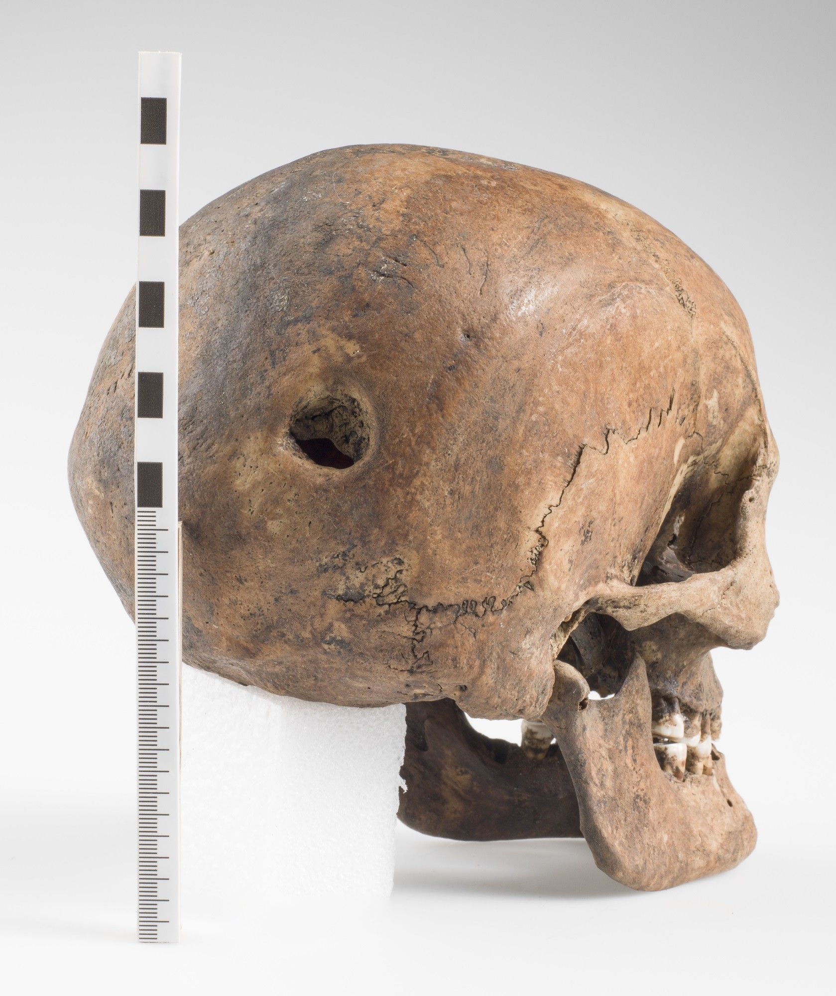 O crânio do homem SK259 analisado pela equipe internacional de pesquisadores  (Foto: Stian Suppersberger Hamre et.al )