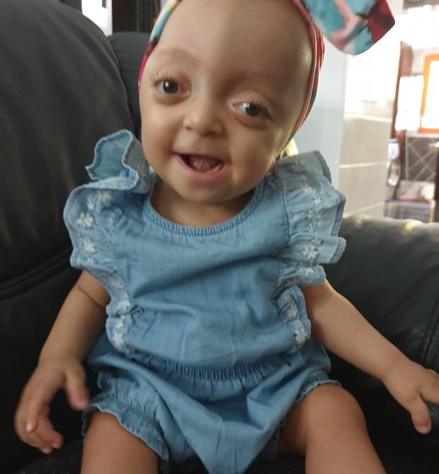 Bebê precisou passar por cirurgia craniana para reverter síndrome rara (Foto: Reprodução/Facebook/Maggy Capatti)