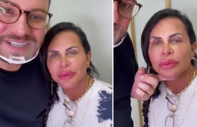 Gretchen fez um preenchimento labial e mostrou o resultado nas redes  (Foto: Reprodução)