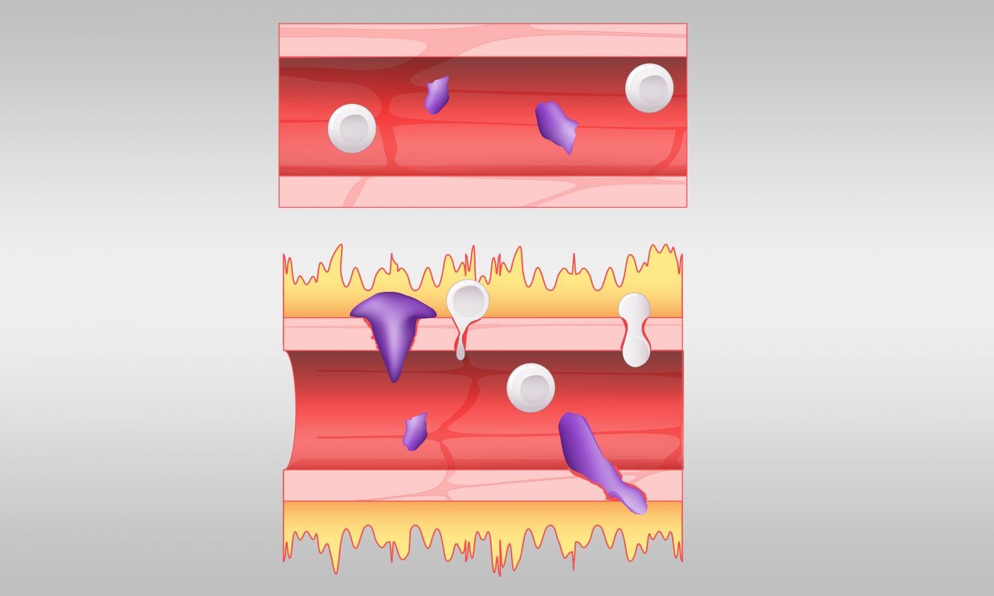 No topo da imagem, ilustração mostra como se comporta um vaso sanguíneo normal. Abaixo dele, ilustra-se os vazamentos provocados pelo excesso de bradicinina nos vasos (Foto: Jason Smith/ORNL, Departamento de Energia dos EUA)