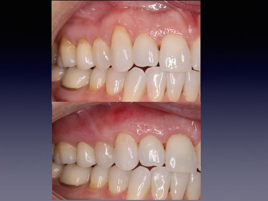 Photo of Mona Mahmoodi, DDS - Park Plaza Dental - Petaluma, CA, US. Pinhole Gum Rejuvenation to cover gum recession performed by Dr Mona