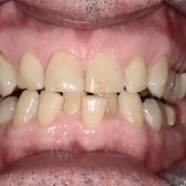 Case #2.  Before Invisalign with lower crowding.