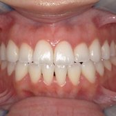 After Invisalign.  Now the patient can bite with the front teeth.