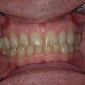 Case #2.  After Invisalign.  Now the patient can clean better in between the teeth.