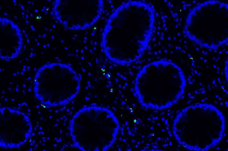 Long COVID uncharacteristic immune cell activity and SARS-CoV-2 RNA in the gut seen two years after infection