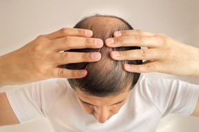 Could a cure for baldness be on the way?