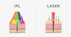 laser vs ILP