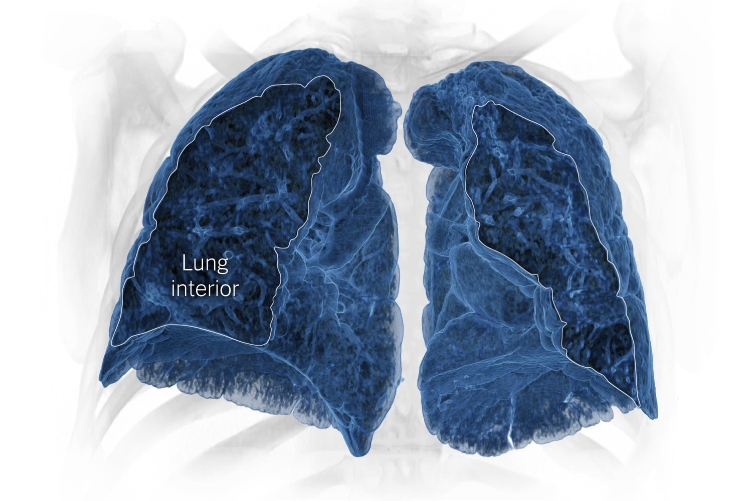 Cinematic renderings of CT scans can show the lasting damage to a person’s lungs after severe Covid infection.