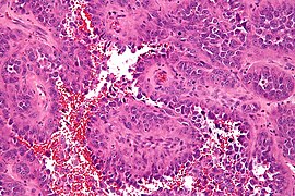 Epithelioid angiosarcoma - high mag.jpg