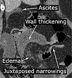 CT scan of a small bowel volvulus. It shows two juxtaposed segments of narrowing, which is the spot of mesentery rotation. The other signs indicate strangulation.