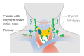 Stage N1b thyroid cancer