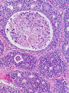 Adenoid cystic carcinoma with comedonecrosis