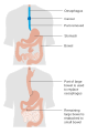 An esophagectomy using the bowel (colon) to replace the esophagus