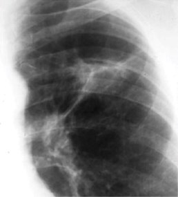 Chest x-ray of Ghon's complex of active tuberculosis