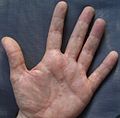 Palmar dyshidrosis