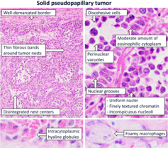 Histopathology of solid pseudopapillary tumor[9]