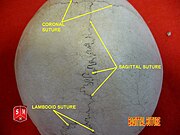 Skull seen from top. Sagittal suture separates left and right parietal bone.