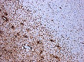 زول النخاعين بواسطة التصلب اللويحي. يُظهر النسيج المُلون بالبروتين السكري سي دي 68 (بروتين) يظهر عدة خلايا أكولة كبيرة في منطقة النسيج المتضرر