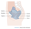 Diagram showing the area removed with a total operation