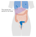 Stage 4B cervical cancer