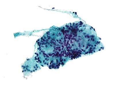 Micrograph of adenoid cystic carcinoma, fine needle aspiration specimen, Pap stain