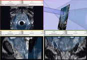 ProstateNav Module for MRI guided robot assisted biopsy of the prostate.