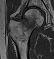 T1-weighted, turbo spin echo, MRI confirms a fracture, as the surrounding bone marrow has low signal from edema.