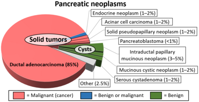 Relative incidences[spelling?] of various pancreatic neoplasms, with solid pseudopapillary neoplasm annotated at center right.[10]