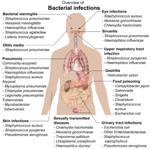 chart showing bacterial infections upon various parts of human body