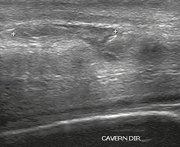 Figure 4 A: Ultrasound of the penis, right lateral view. Longitudinal section showing rupture of the tunica albuginea with an adjacent 1.92 cm hematoma (between calipers), due to trauma.[1]