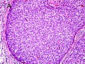 Gleason score 10 (5+5) with solid sheets of cells