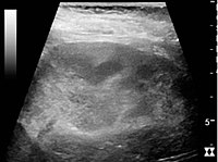 Renal ultrasonograph of acute pyelonephritis with increased cortical echogenicity and blurred delineation of the upper pole.[18]