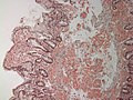 Small bowel duodenum with amyloid deposition Congo red 10X