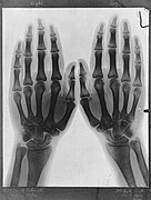 Radiograph of hands by Arthur Schuster