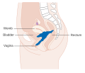 Stage 4A cervical cancer