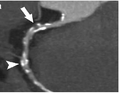 CT-Angiography يبين تصلب في الشرايين