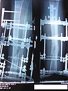 X-ray of the callus forming at the fracture site, three months post-fracture; perspective 3-4.