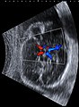 Fetal ultrasound image at the level of circle of Willis, showing PCA, MCA and ACA