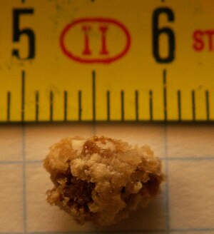 A color photograph of a kidney stone, 8 millimeters in diameter.