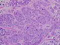 Carcinoma mai ɗorewa mai girma, tare da ƙananan ƙwayar tubule, alamar pleomorphism, da fitattun mitoses, filin 40x