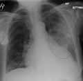 Left upper lobe pneumonia with a small pleural effusion.