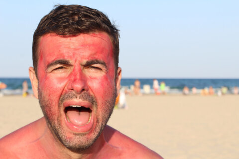 This ‘common’ mistake with sunscreen gets people burned, DC-area dermatologist says