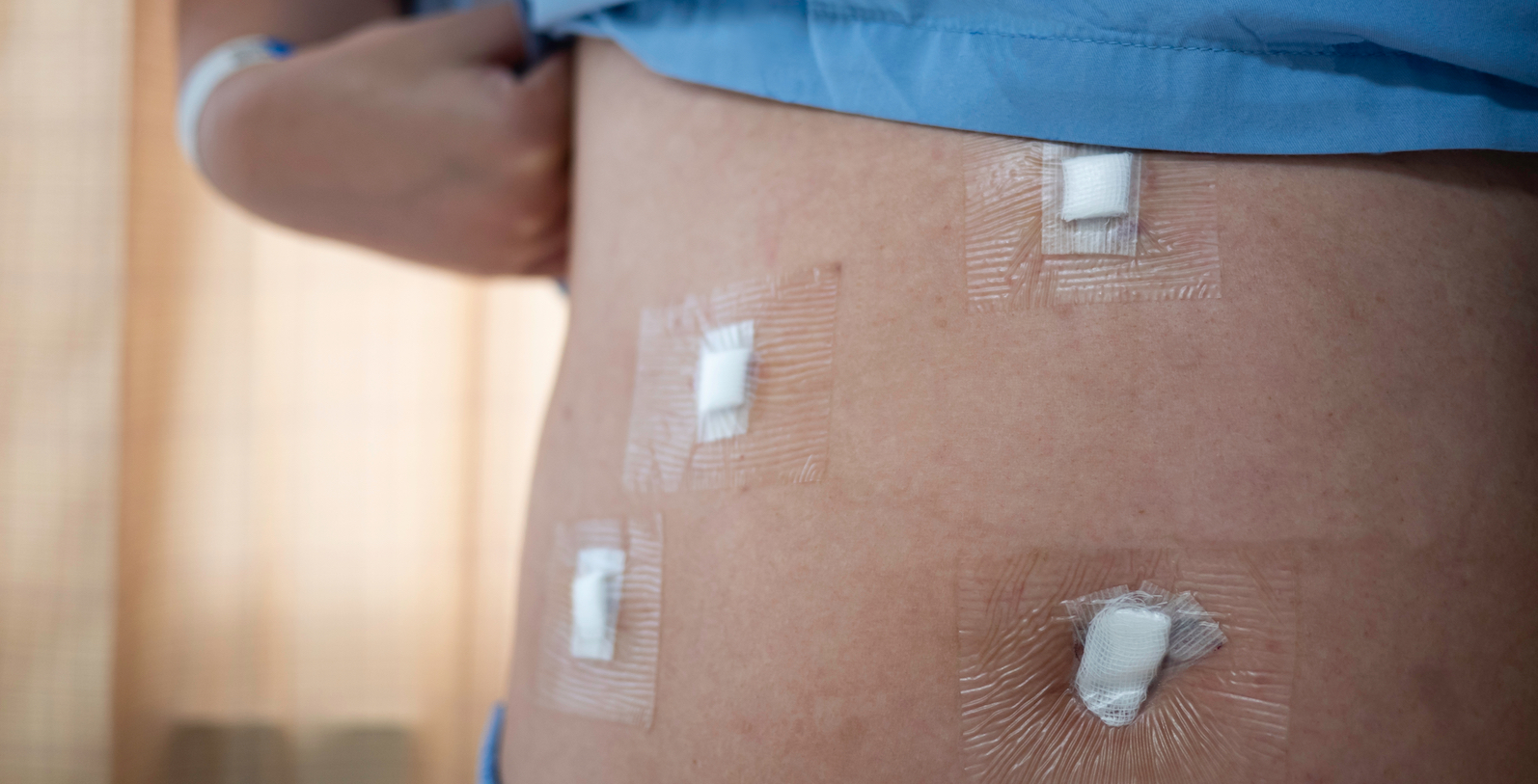 An abdomen of an adult patient with Waterproof Transparent Dressing after Cholecystectomy or Laparoscopic Gallbladder Surgery for gallstones removal.