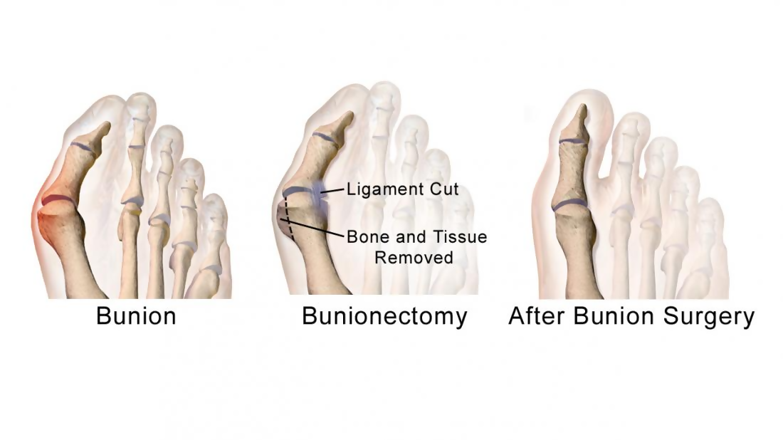 bunion