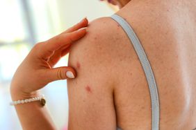 person wearing a spaghetti strap showing body acne on left arm and back and touching left shoulder