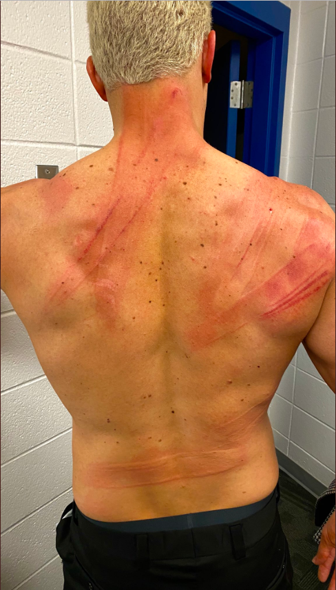  This was the state of Cody Rhodes' back following his lashing