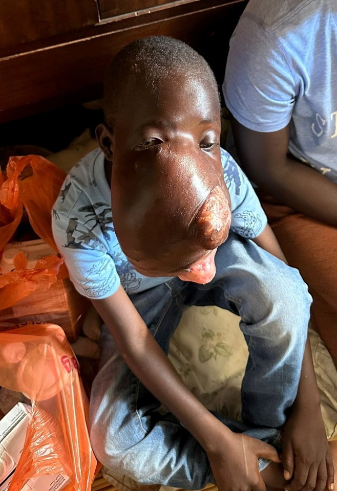 Simbarashe Dande's severe facial tumour started developing at three years old